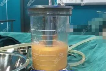 衡水360度水动力吸脂费用多少钱？