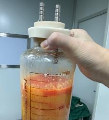 衡水水动力吸脂手术要做多久？